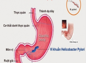 Cách điều trị bệnh viêm hang vị dạ dày 
